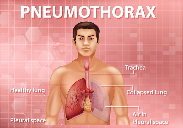 Vettore gratuito illustrazione informativa del pneumotorace