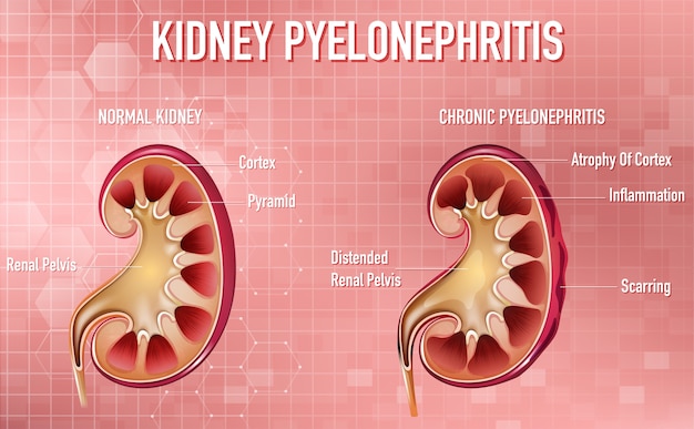 Free vector informative illustration of pyelonephritis