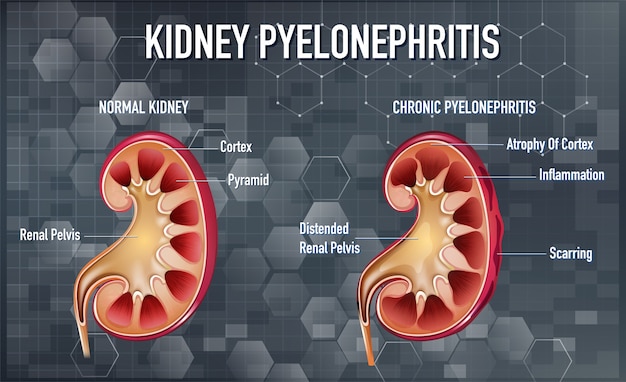 Free vector informative illustration of pyelonephritis