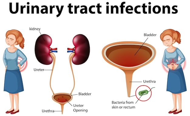 Vettore gratuito illustrazione informativa delle infezioni del tratto urinario