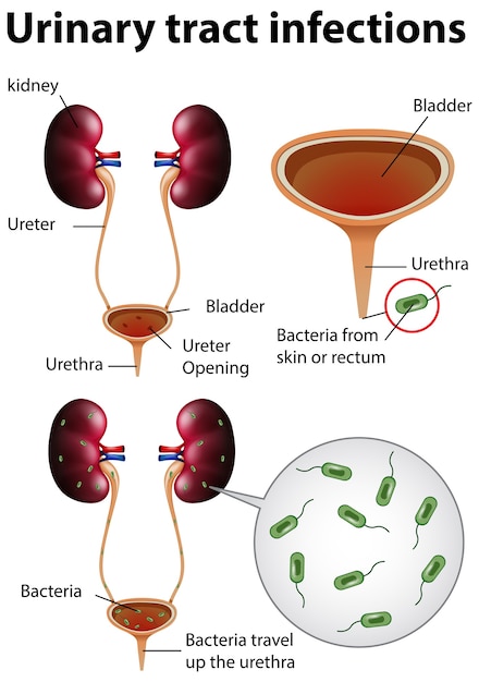 Vettore gratuito illustrazione informativa delle infezioni del tratto urinario