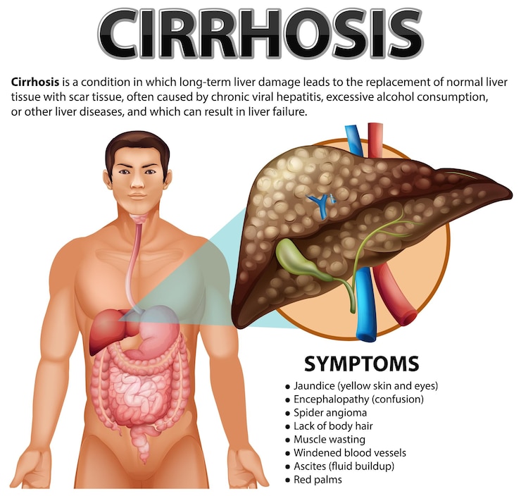 Free Vector informative poster of alcoholic liver disease cirrhosis