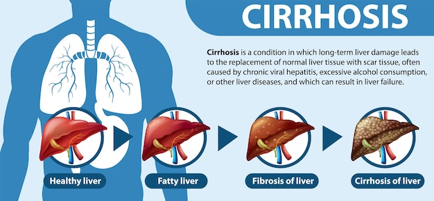 Vettore gratuito poster informativo della malattia epatica alcolica cirrosi