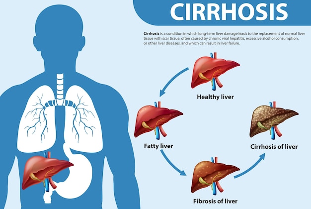 Free vector informative poster of alcoholic liver disease cirrhosis