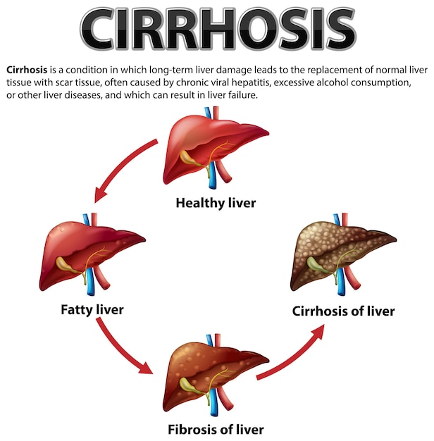 Vettore gratuito poster informativo della malattia epatica alcolica cirrosi