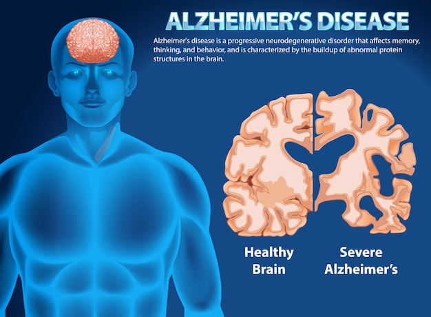 Free vector informative poster of alzheimers disease