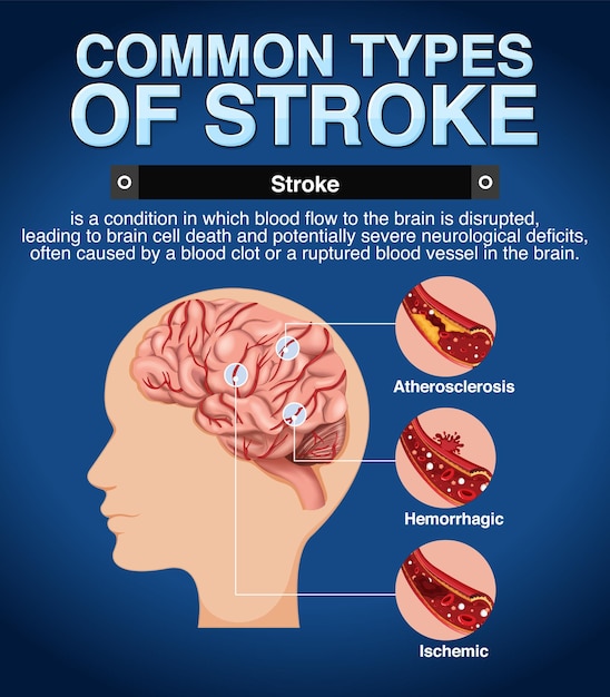 Free vector informative poster of common types of stoke