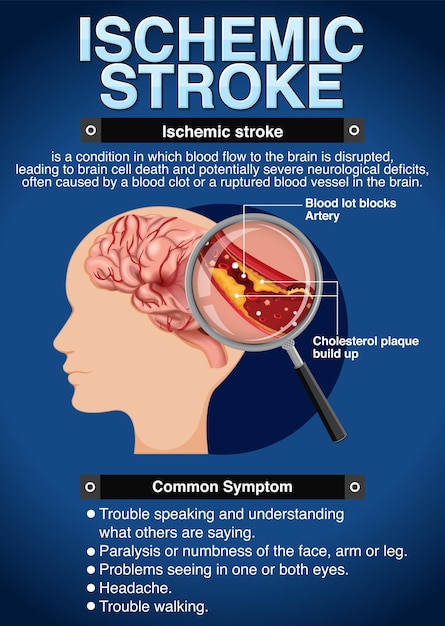 Free vector informative poster of ischemic stroke