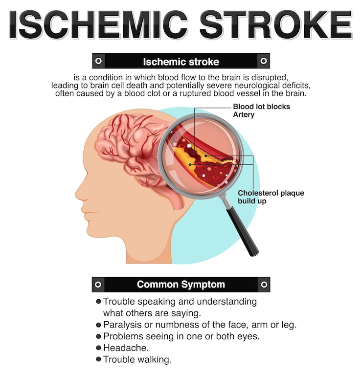 Free Vector informative poster of ischemic stroke
