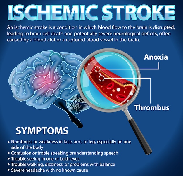 Informative poster of ischemic stroke