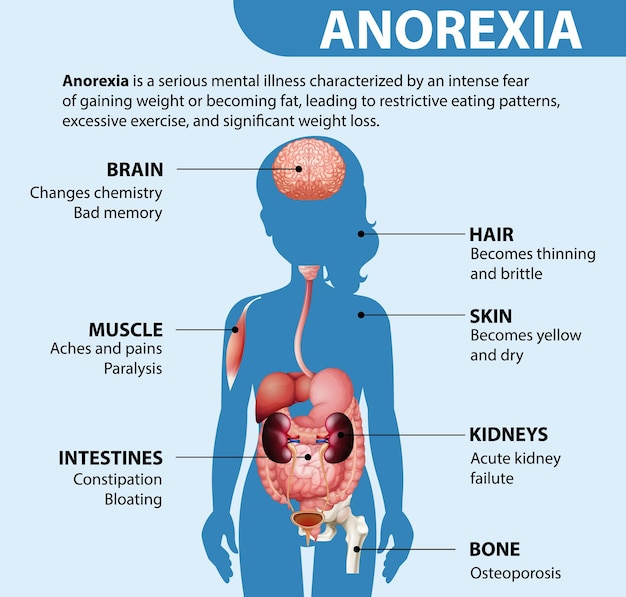 Бесплатное векторное изображение Информативный плакат о расстройстве пищевого поведения анорексии