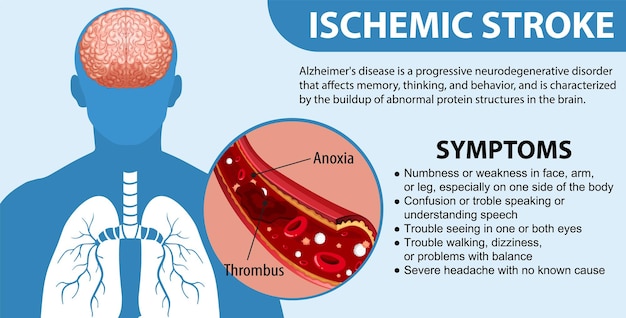 無料ベクター 虚血性脳卒中の有益なポスター