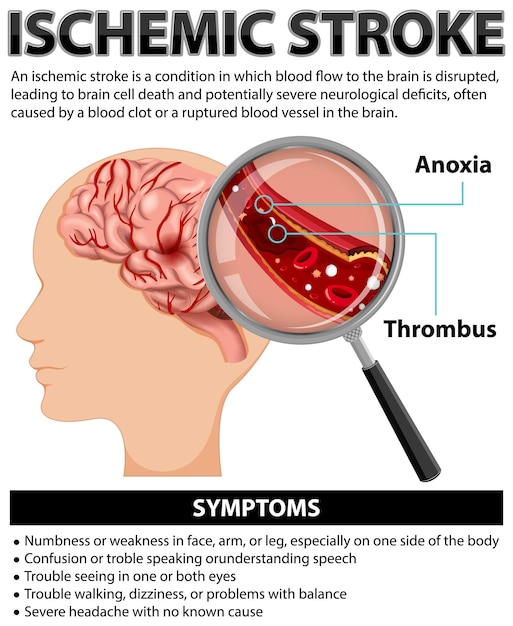Бесплатное векторное изображение Информационный плакат об ишемическом инсульте