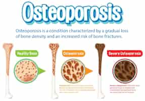 무료 벡터 골다공증 인간 뼈의 유익한 포스터