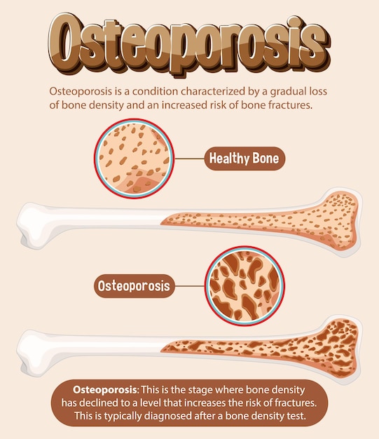 Бесплатное векторное изображение Информационный плакат о остеопорозе человеческой кости