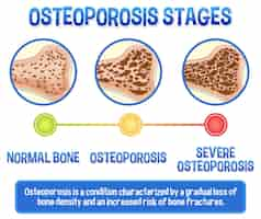 無料ベクター 骨粗しょう症の人間の骨の有益なポスター