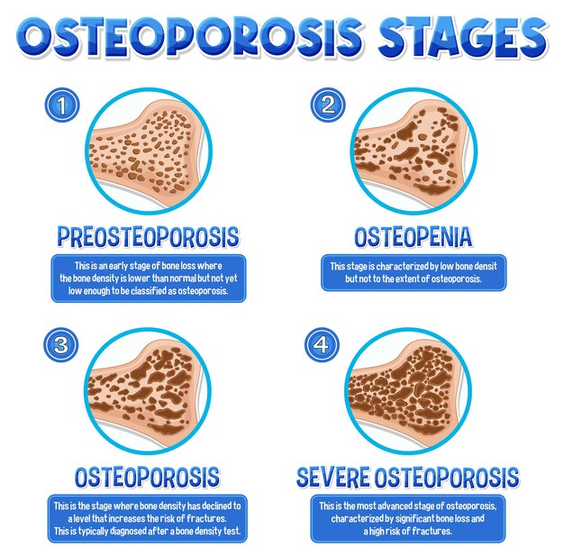 骨粗しょう症の人間の骨の有益なポスター