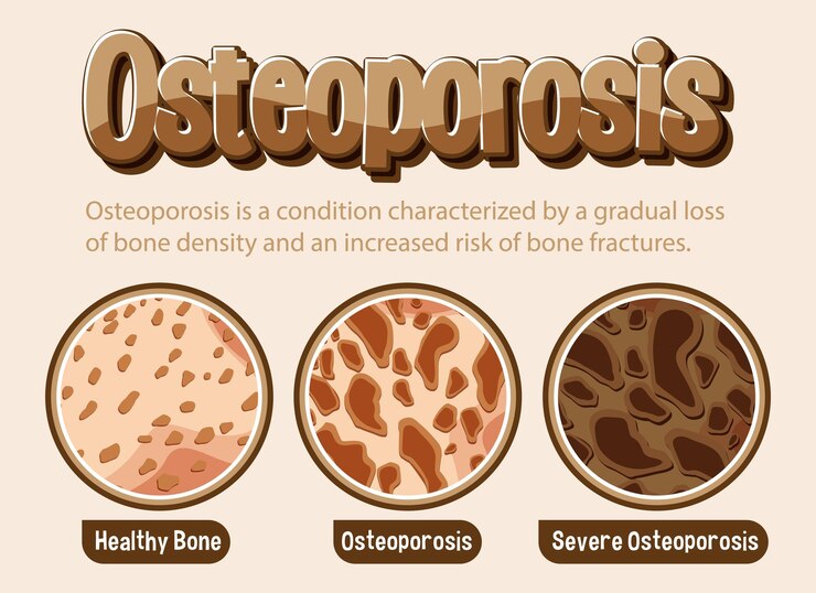 Informative poster of osteoporosis human bone Biology Diagrams