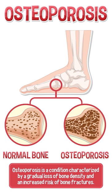 Informative poster of Osteoporosis human bone