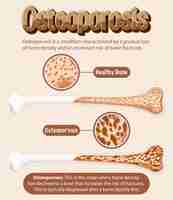 Free vector informative poster of osteoporosis human bone