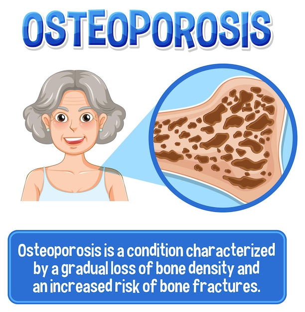 Vettore gratuito poster informativo sull'osso umano dell'osteoporosi