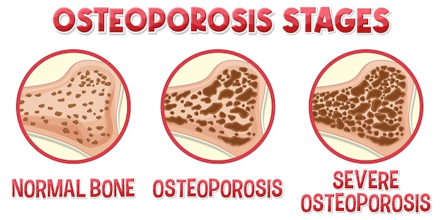 Free vector informative poster of osteoporosis human bone