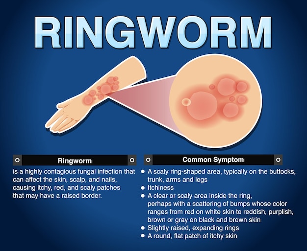 Free vector informative poster of ringworm