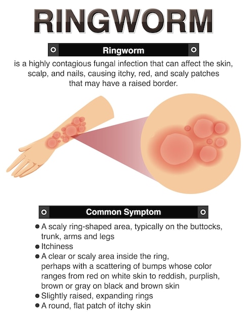 Free vector informative symptoms of ringworm