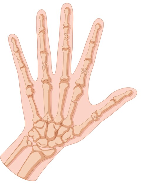 Inside of hand fracture