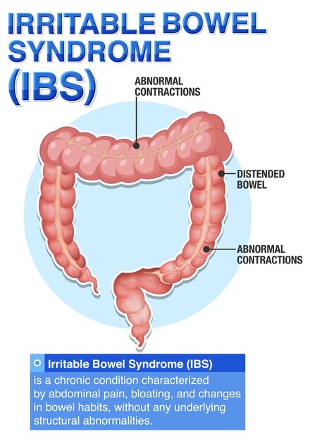irritable bowel syndrome ibs infographic