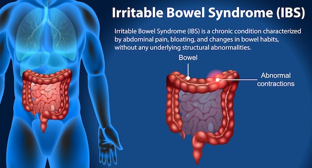 Free vector irritable bowel syndrome ibs infographic