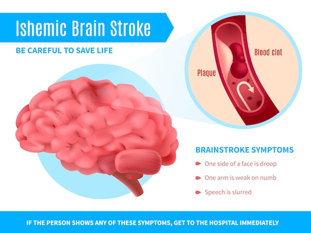 Ischemic brain stroke poster