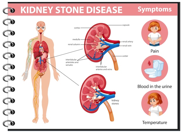 Free vector kidney stones disease and symptoms infographic