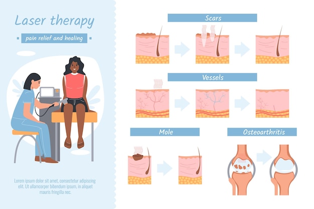 Infografica piatta per terapia laser con vista del diagramma medico della depilazione della struttura della pelle e illustrazione vettoriale dei caratteri umani