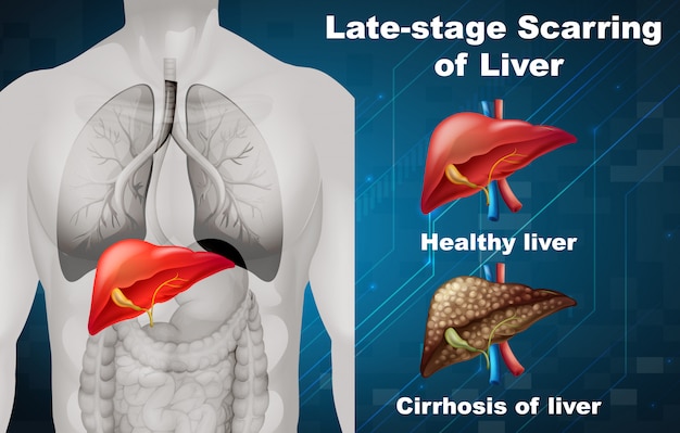 Free vector late-stage scarring of liver