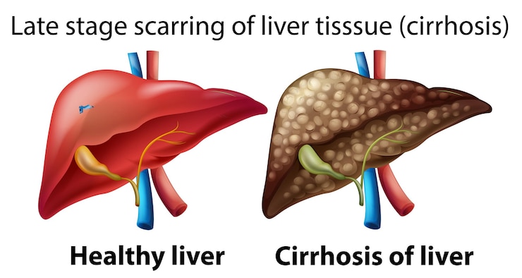 Free Vector late-stage scarring of liver