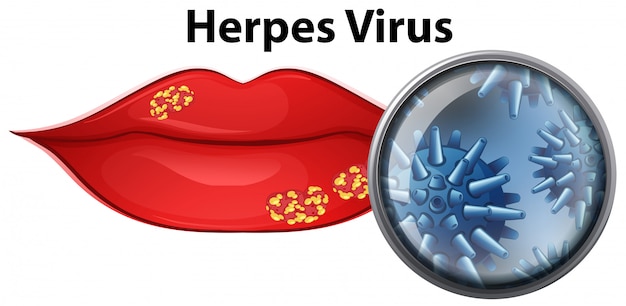 Vettore gratuito un labbro con il virus dell'herpes