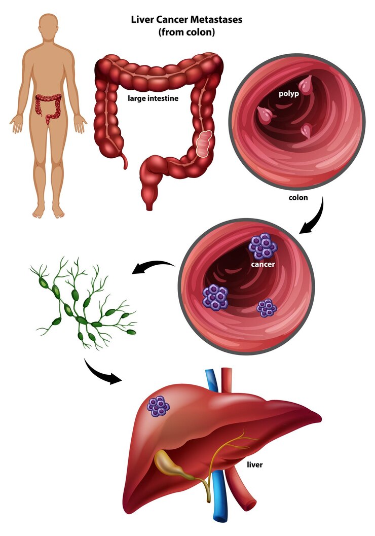 Free Vector liver cancer metastasis from colon