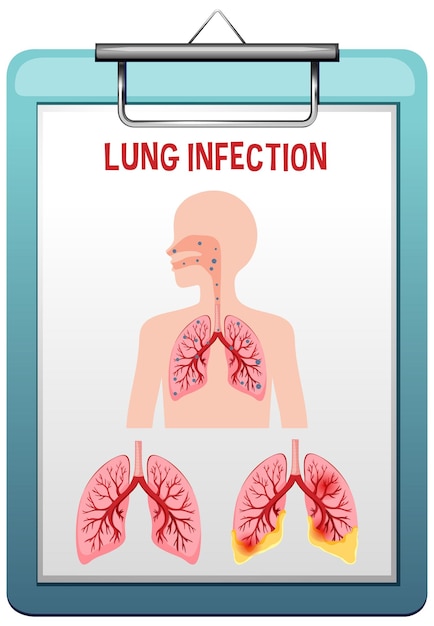 Бесплатное векторное изображение Вектор легочной инфекции пневмонии