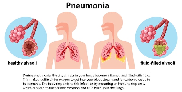 Free vector lung infection pneumonia with explanation