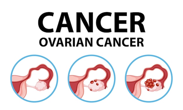 Infografica di anatomia medica consapevolezza del cancro ovarico della donna