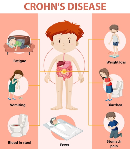 Free vector medical infographic of crohn's disease