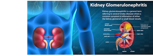 Medical infographic of kidney glomerulosclerosis