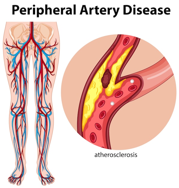 Бесплатное векторное изображение Медицинское заболевание периферических артерий