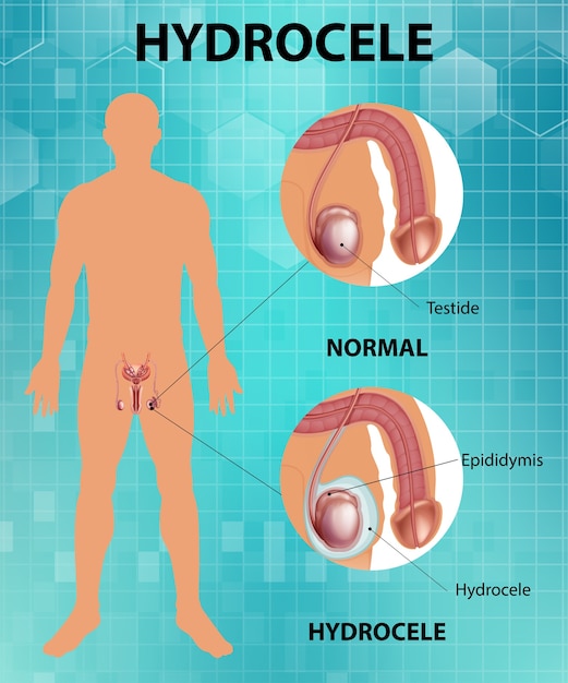 Medical poster showing different between male normal testicle\
and hydrocele