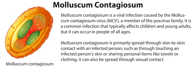 Vettore gratuito mollusco contagioso con spiegazione