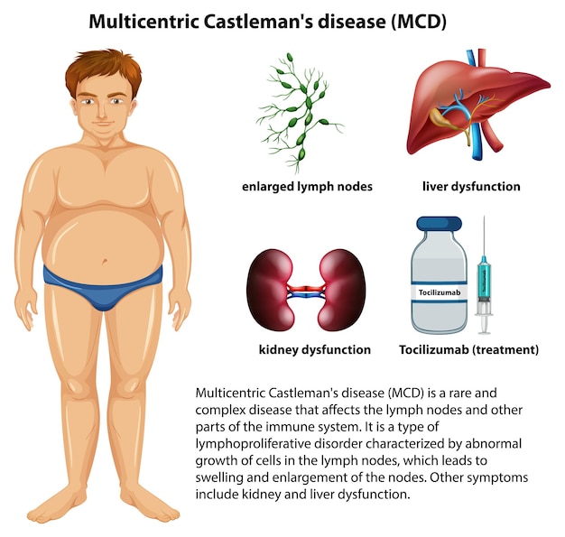 Vettore gratuito infografica mcd multicentrica della malattia di castleman