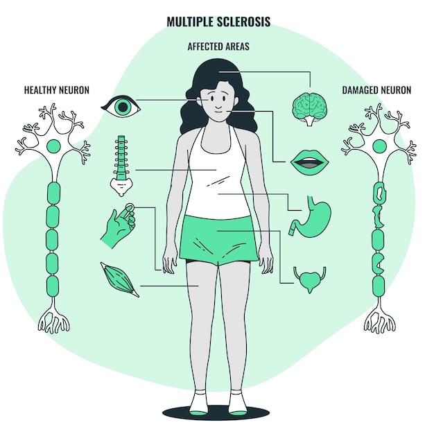 Vettore gratuito illustrazione del concetto di sclerosi multipla