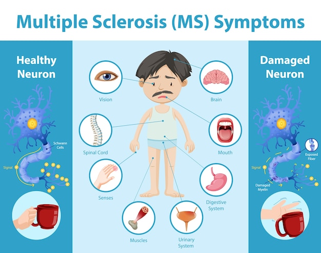 Free vector multiple sclerosis (ms) symptoms information infographic