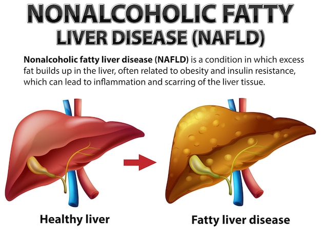 Steatosi epatica non alcolica